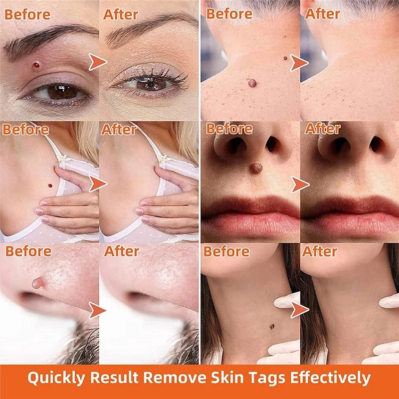 Flat and sharp warts, with a warm and moisturizing facial warts remover